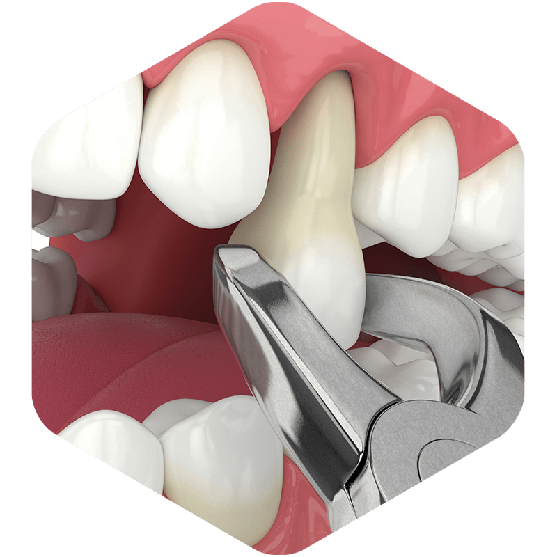 3D illustration of a tooth extraction.
